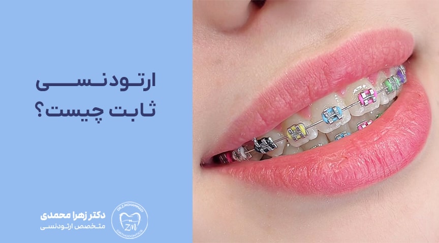 ارتودنسی ثابت چیست؟