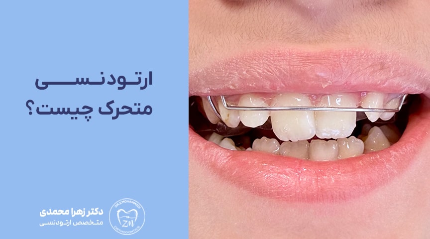 ارتودنسی متحرک