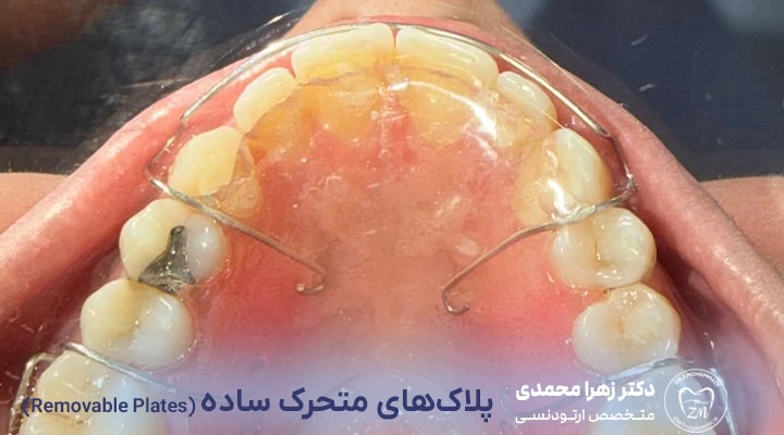 ارتودنسی متحرک