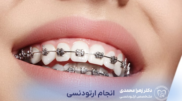بهترین زمان برای انجام ارتودنسی