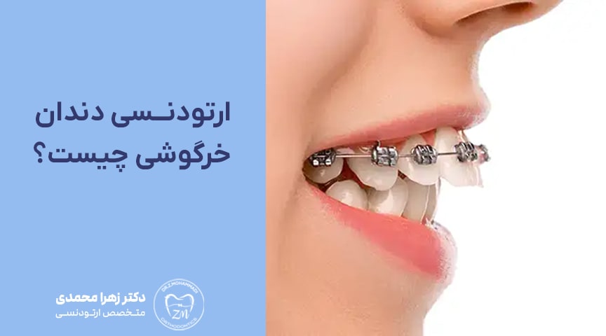 ارتودنسی دندان خرگوشی