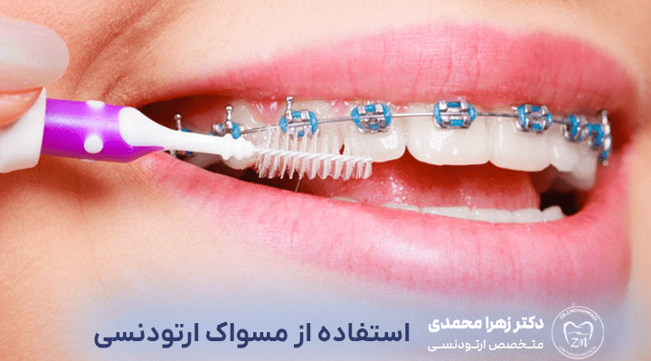 استفاده از مسواک ارتودنسی
