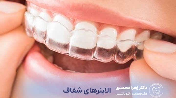 بهترین روش ارتودنسی برای دندان‌های روکش شده