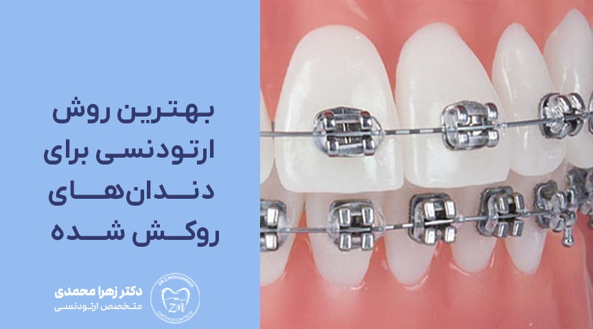 بهترین روش ارتودنسی دندان‌های روکش شده
