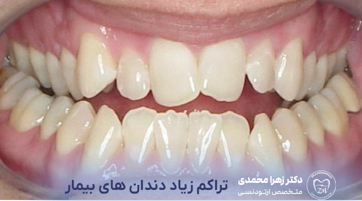 دلایل اصلی لق شدن دندان در طول ارتودنسی