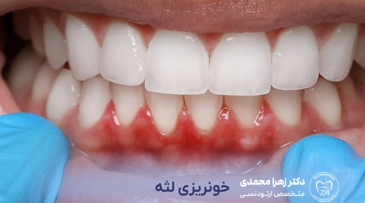 بیماری‌های لثه قبل از شروع ارتودنسی