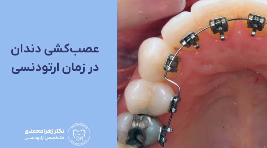 عصب‌کشی دندان در زمان ارتودنسی؛ راهنمای کامل بیماران