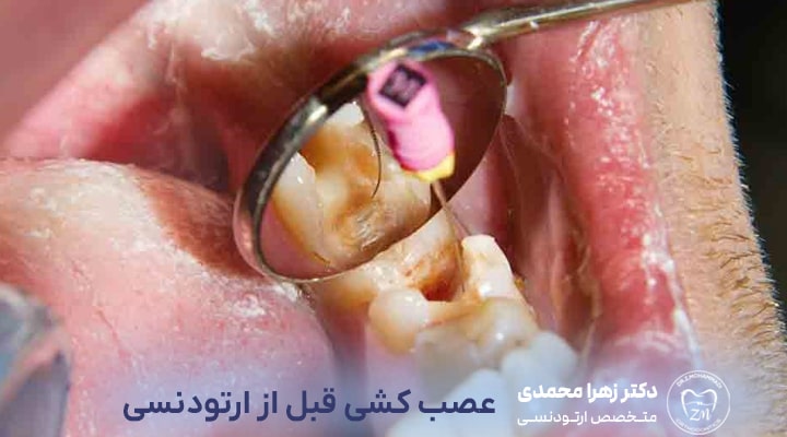 عصب‌کشی قبل از ارتودنسی