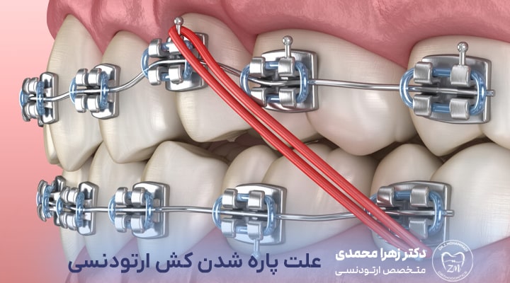 علت پاره شدن کش ارتودنسی