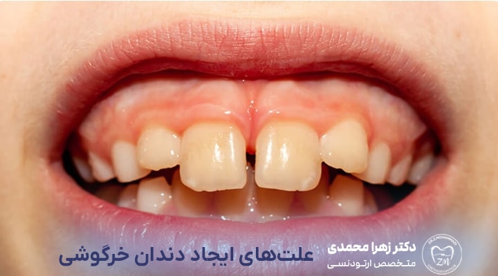 علت‌های ایجاد دندان خرگوشی