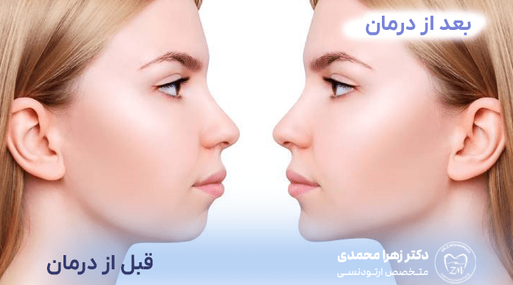 عوارض درمان نکردن دندان خرگوشی