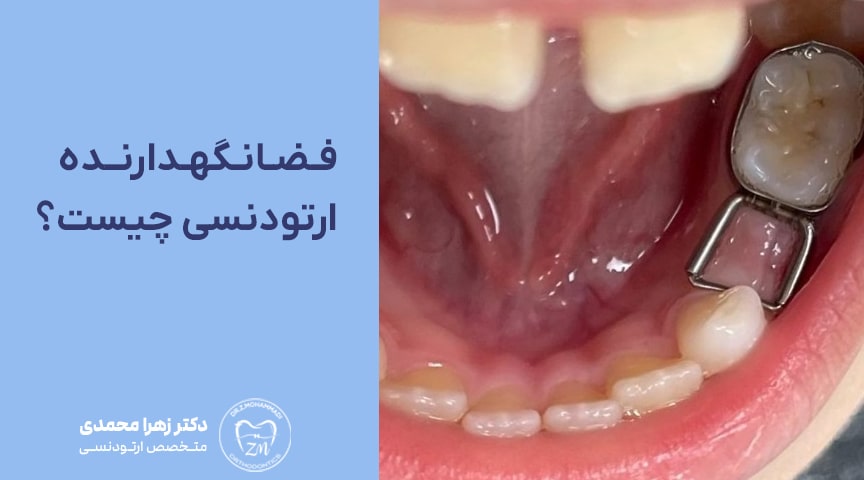فضانگهدار ارتودنسی چیست و چه کاربردی دارد؟