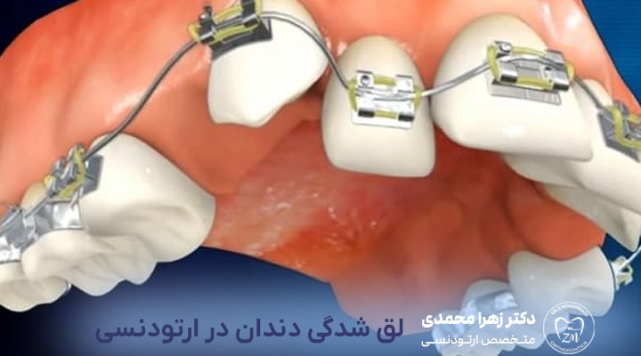 آیا لق شدن دندان در ارتودنسی طبیعی است؟