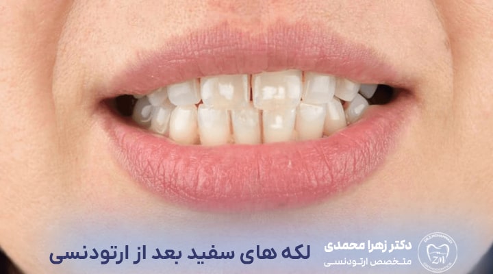 علت لکه‌های سفید بعد از ارتودنسی