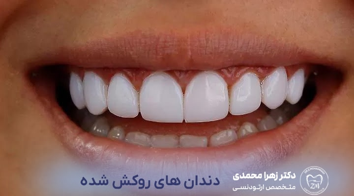 تفاوت ارتودنسی دندان‌های روکش شده با دندان‌های طبیعی