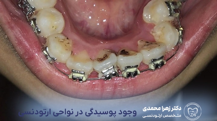 علت پوسیدگی دندان در هنگام ارتودنسی