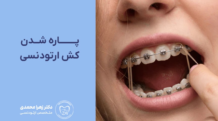 پاره شدن کش ارتودنسی ؛ علت، علائم و راه‌های پیشگیری