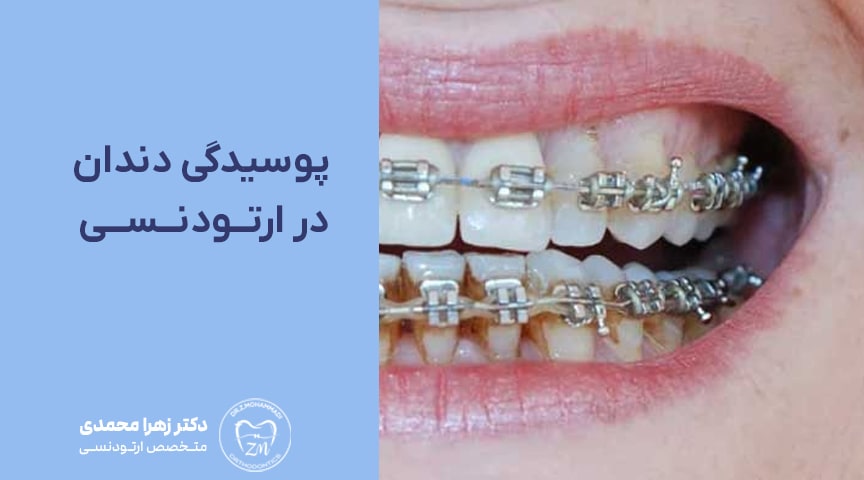 پوسیدگی دندان در ارتودنسی