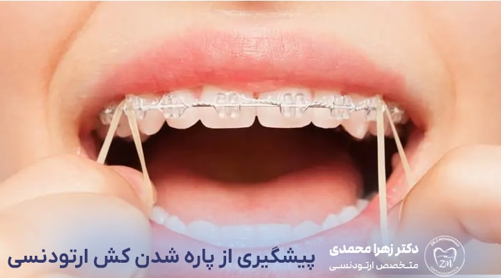روش‌های پیشگیری از پاره شدن کش ارتودنسی
