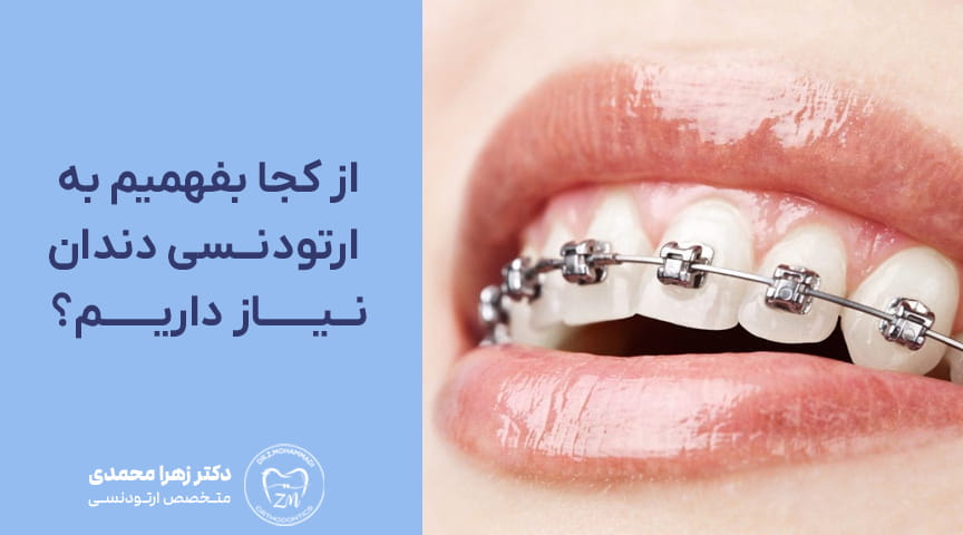 از کجا بفهمیم به ارتودنسی دندان نیاز داریم؟