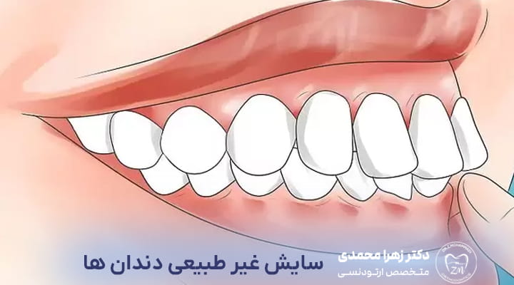 مشکلات فکی و بایت؛ نشانههای پنهان نیاز به ارتودنسی