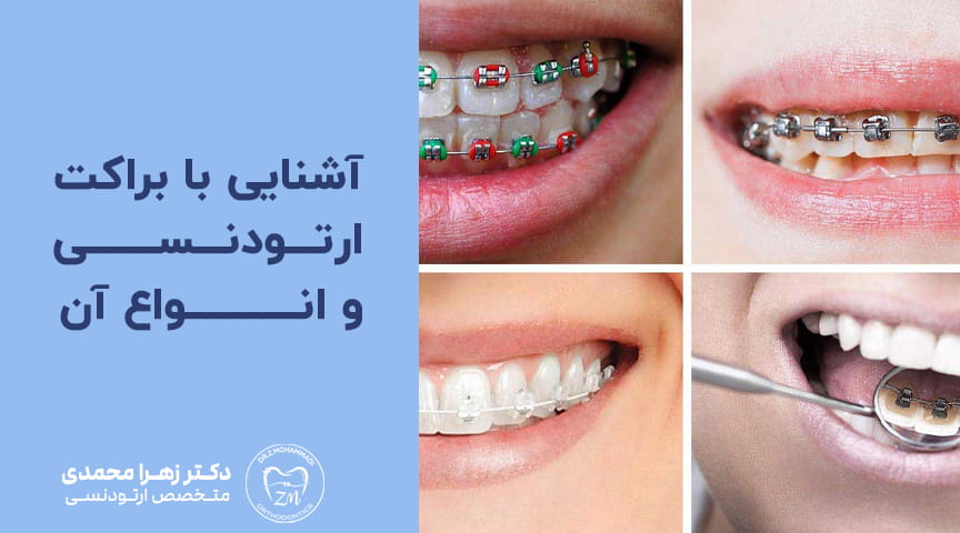 آشنایی با براکت ارتودنسی و انواع آن