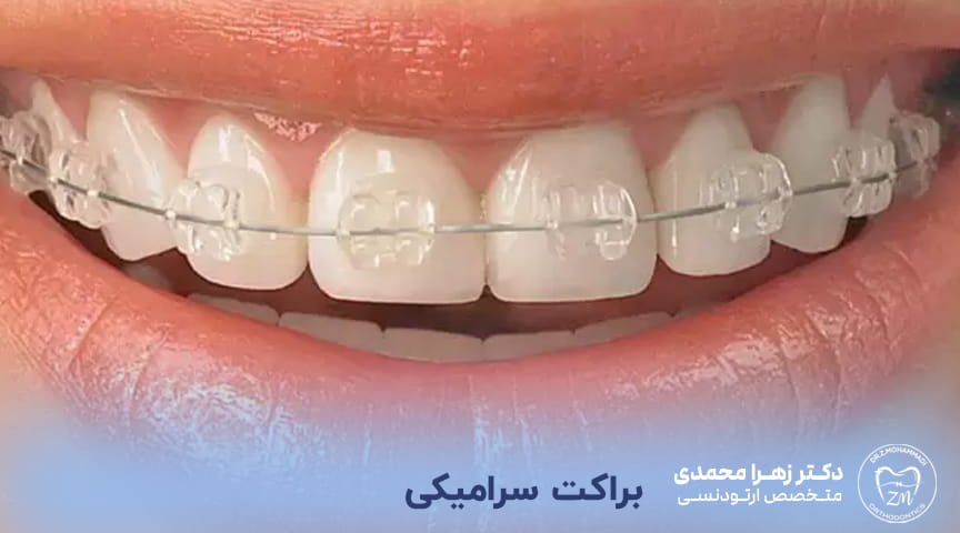 براکت سرامیکی ارتودنسی