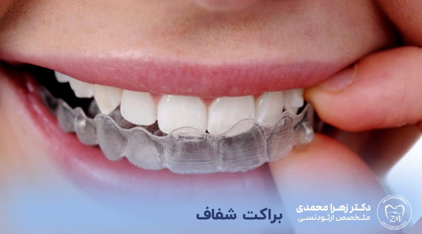 براکت شفاف