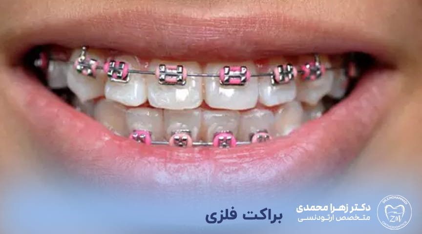 براکت فلزی