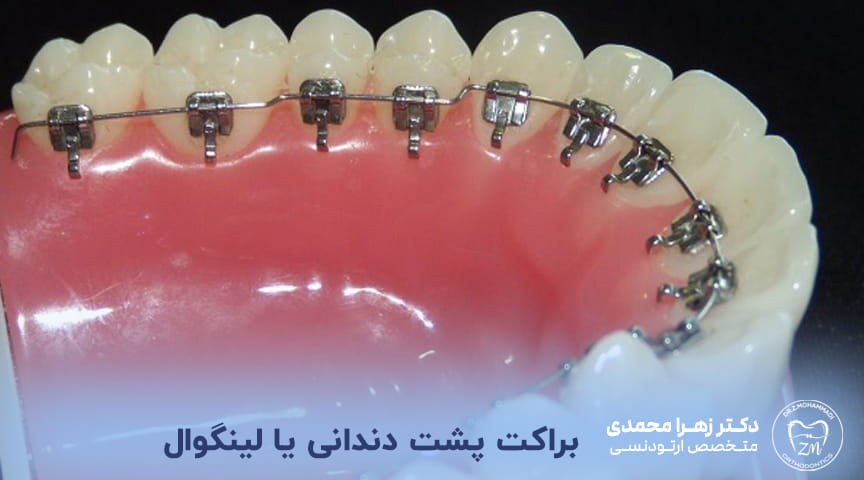 براکت لینگوال (پشت دندانی)