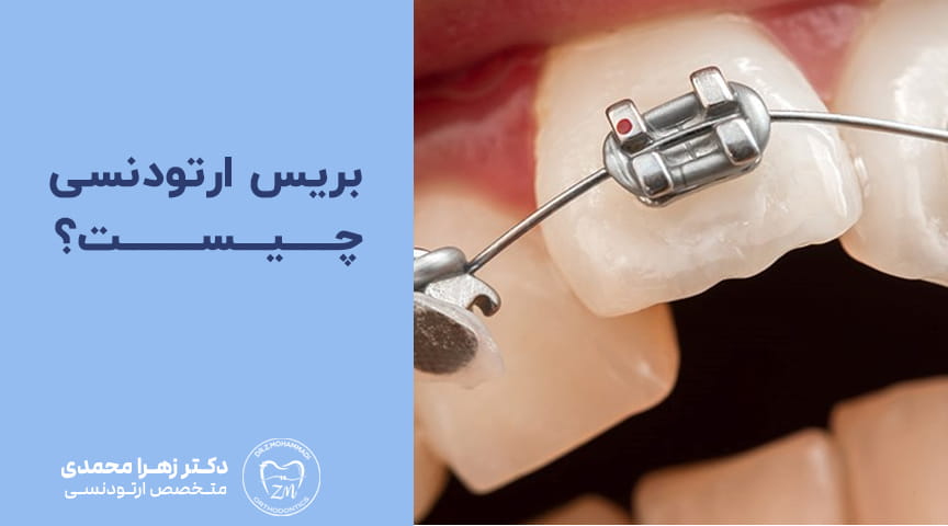 بریس ارتودنسی چیست؟