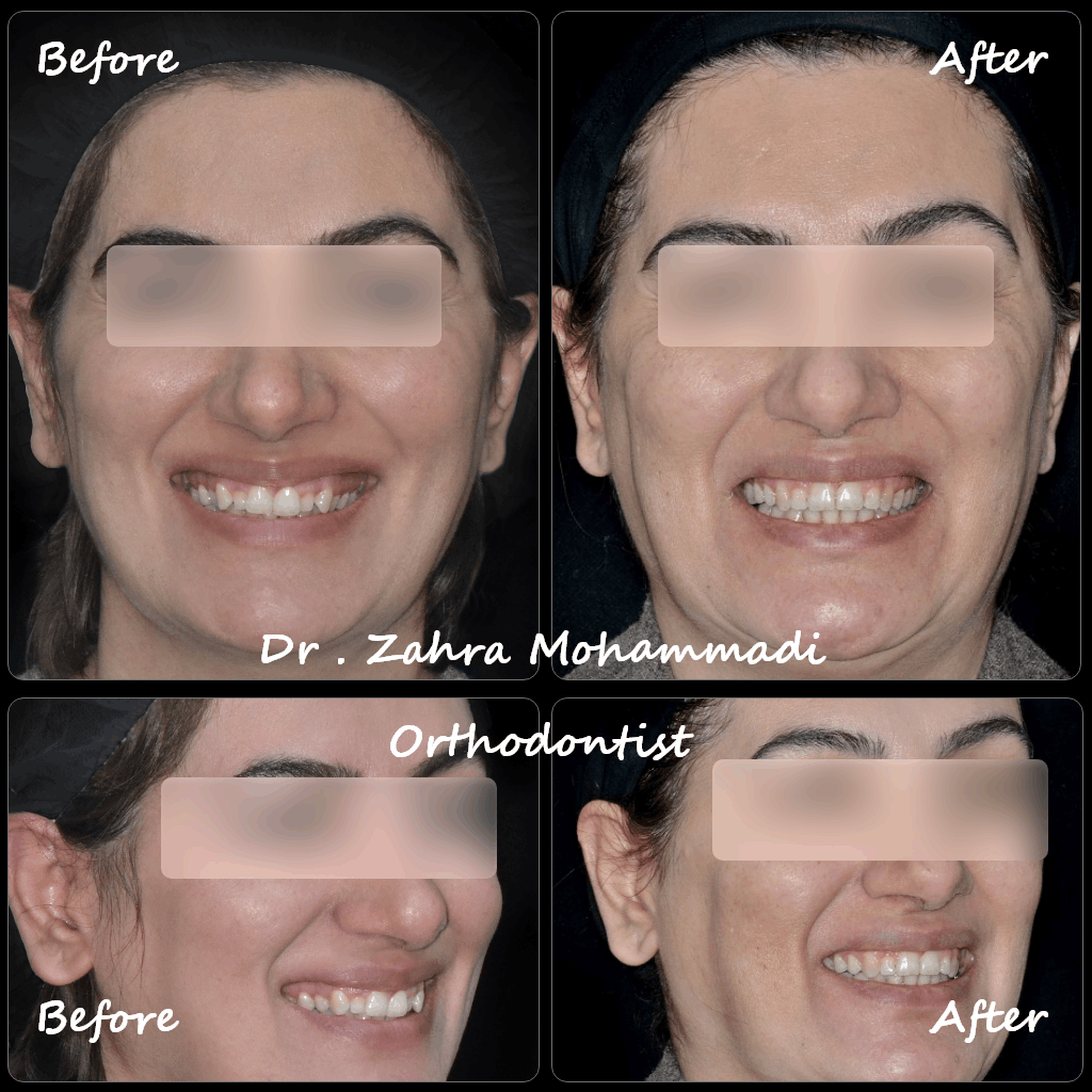 نمونه کار ارتودنسی ثابت دو فک در ۴۸ سالگی | اصلاح نامرتبی دندان‌ها بدون محدودیت سنی