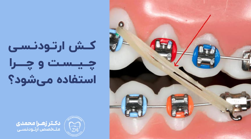 کش ارتودنسی چیست و چرا استفاده می_شود؟