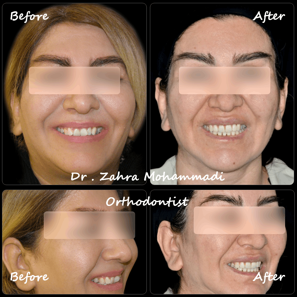 نمونه کار ارتودنسی ثابت دو فک در ۴۰ سالگی | اصلاح نامرتبی شدید دندان‌ها با درمان تخصصی