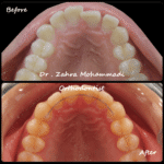 نمونه درمان ارتودنسی ثابت دو فک بدون جراحی – اصلاح نامرتبی دندان‌ها در بیمار با عقب‌بودگی فک پایین