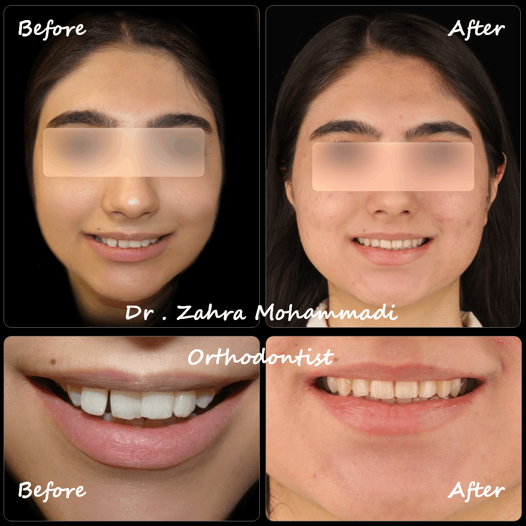 نمونه درمان ارتودنسی ثابت دو فک بدون جراحی – اصلاح نامرتبی دندان‌ها در بیمار با عقب‌بودگی فک پایین