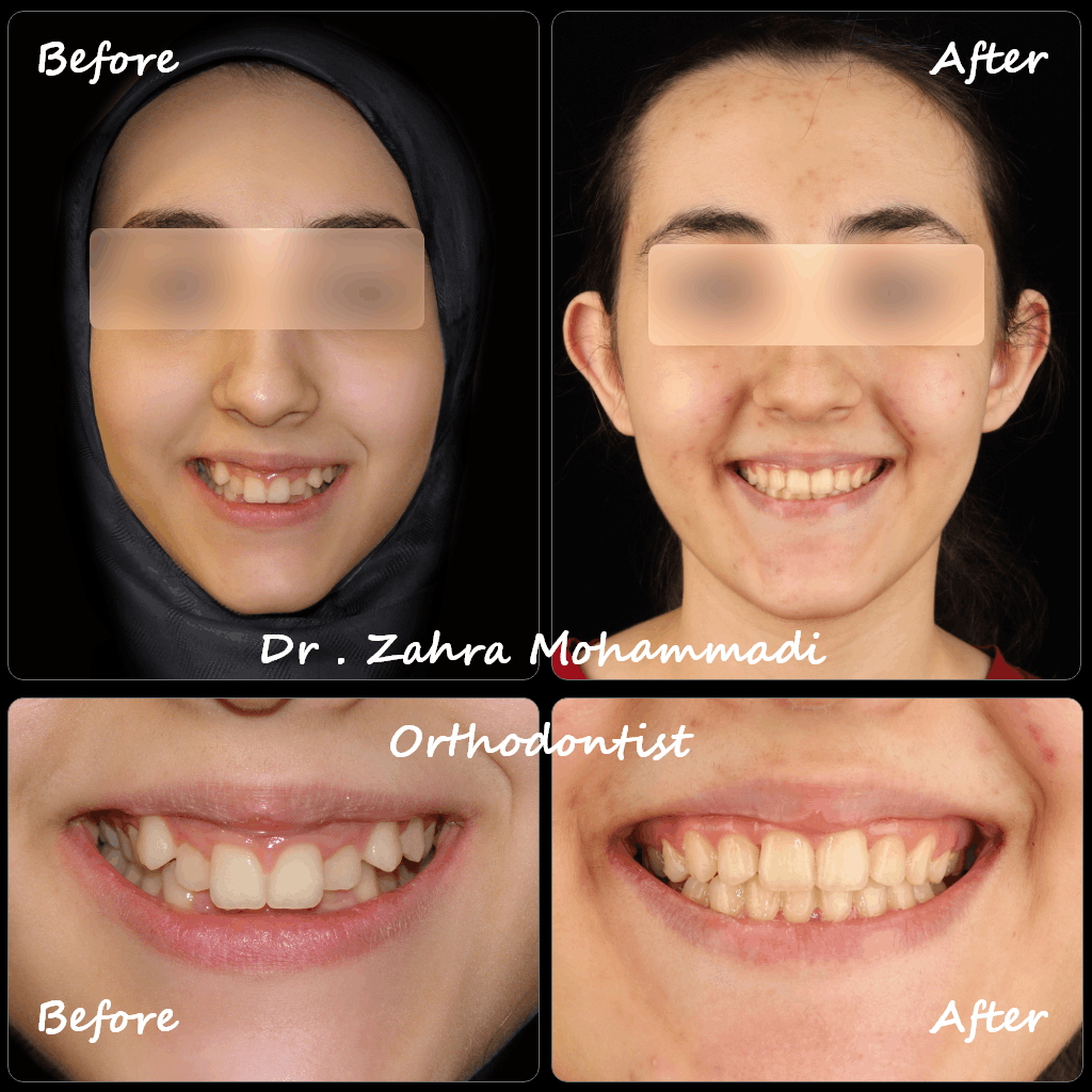 ارتودنسی کودکان و نوجوانان | درمان دیپ بایت، Scissor Bite و نامرتبی دندان‌ها