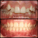 ارتودنسی کودکان و نوجوانان | درمان دیپ بایت، Scissor Bite و نامرتبی دندان‌ها