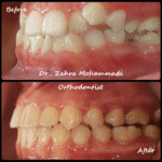 ارتودنسی ثابت دو فک بدون کشیدن دندان اضافی | درمان نامرتبی شدید دندان‌ها
