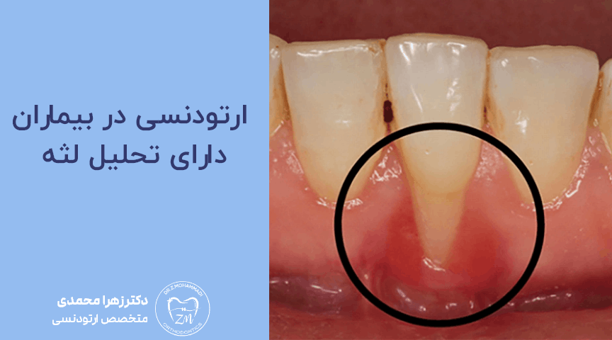 ارتودنسی در بیماران دارای تحلیل لثه