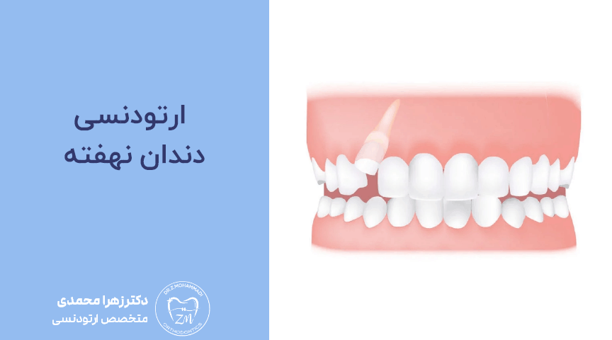 ارتودنسی دندان نهفته