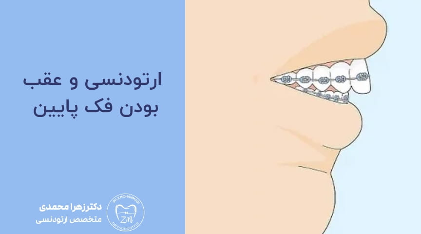 ارتودنسی و عقب بودن فک پایین ؛ چه زمانی درمان بدون جراحی امکان‌پذیر است؟
