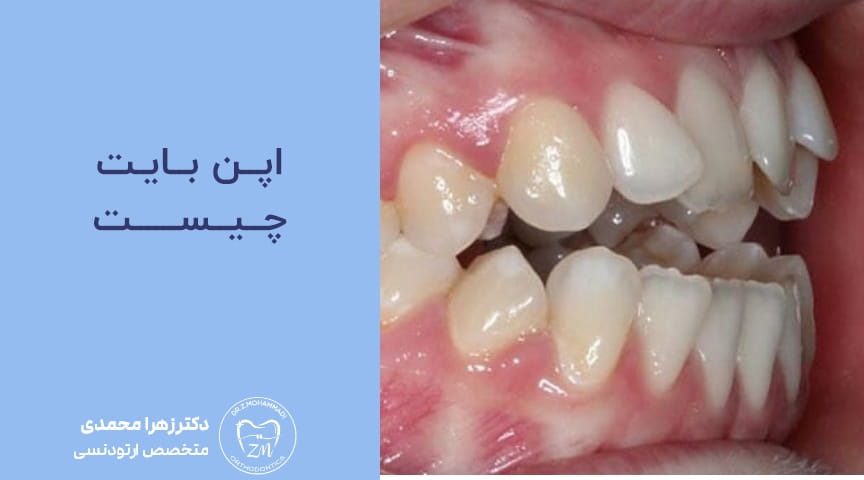اپن بایت چیست و چگونه اصلاح می‌شود؟