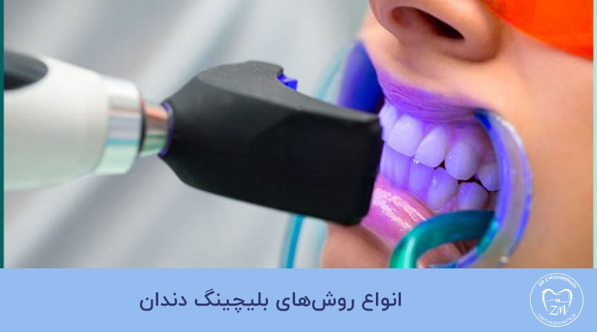 بلیچینگ دندان چیست؟
