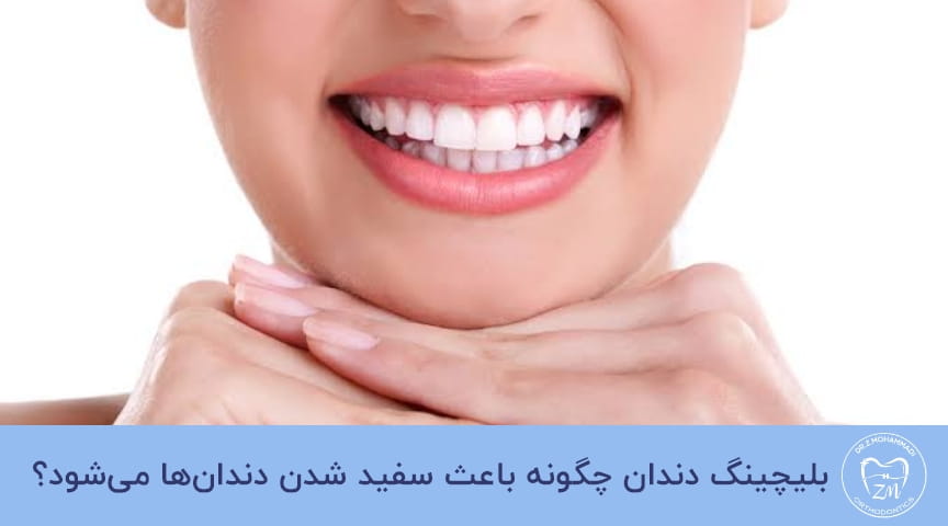 بلیچینگ دندان چیست؟