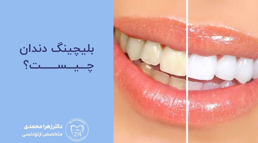 بلیچینگ دندان چیست؟