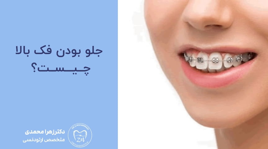 جلو بودن فک بالا ؛ آیا ارتودنسی می‌تواند این ناهنجاری را اصلاح کند؟