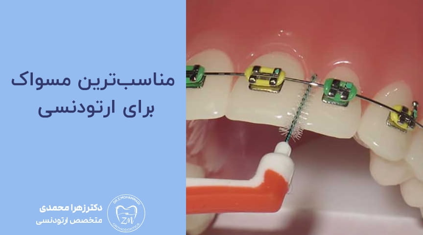 مناسب‌ترین مسواک برای ارتودنسی