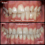 نمونه درمان ارتودنسی ثابت دو فک در ۲۴ سالگی – اصلاح کراس بایت یکطرفه