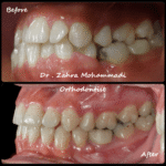 نمونه درمان ارتودنسی ثابت دو فک در ۲۴ سالگی – اصلاح کراس بایت یکطرفه